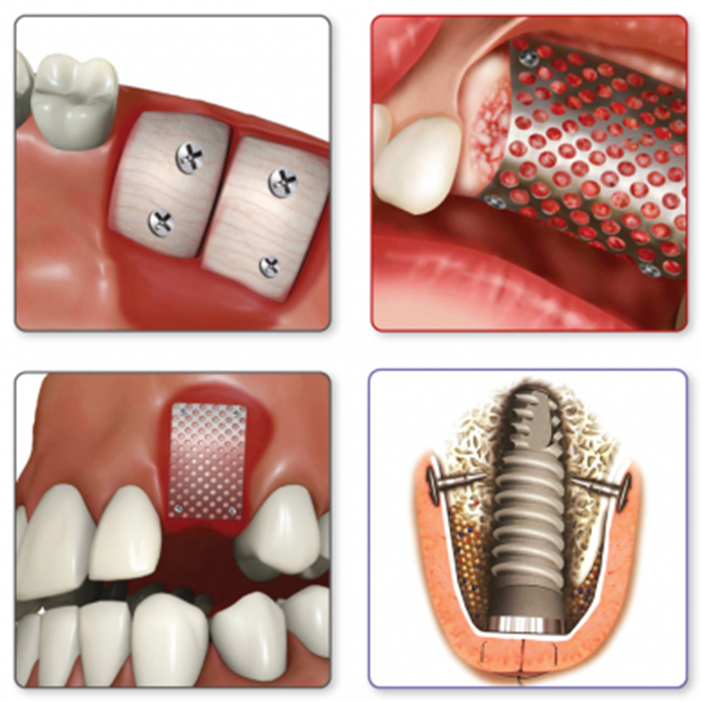 Julldent Membrane Stabilizing Kit and Refills