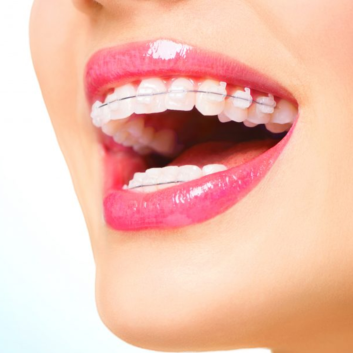 Koden Ceramic MBT Metal Slot Bracket Kits 