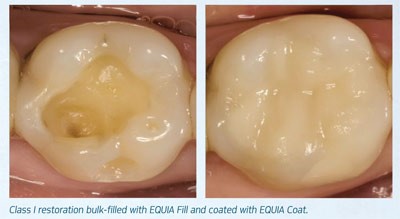 Voco Meron Plus GIC Luting Liquid/ Powder Refills