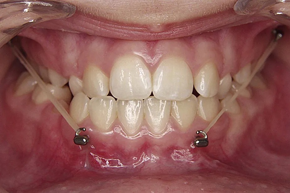 Captain Ortho Colour Elastics