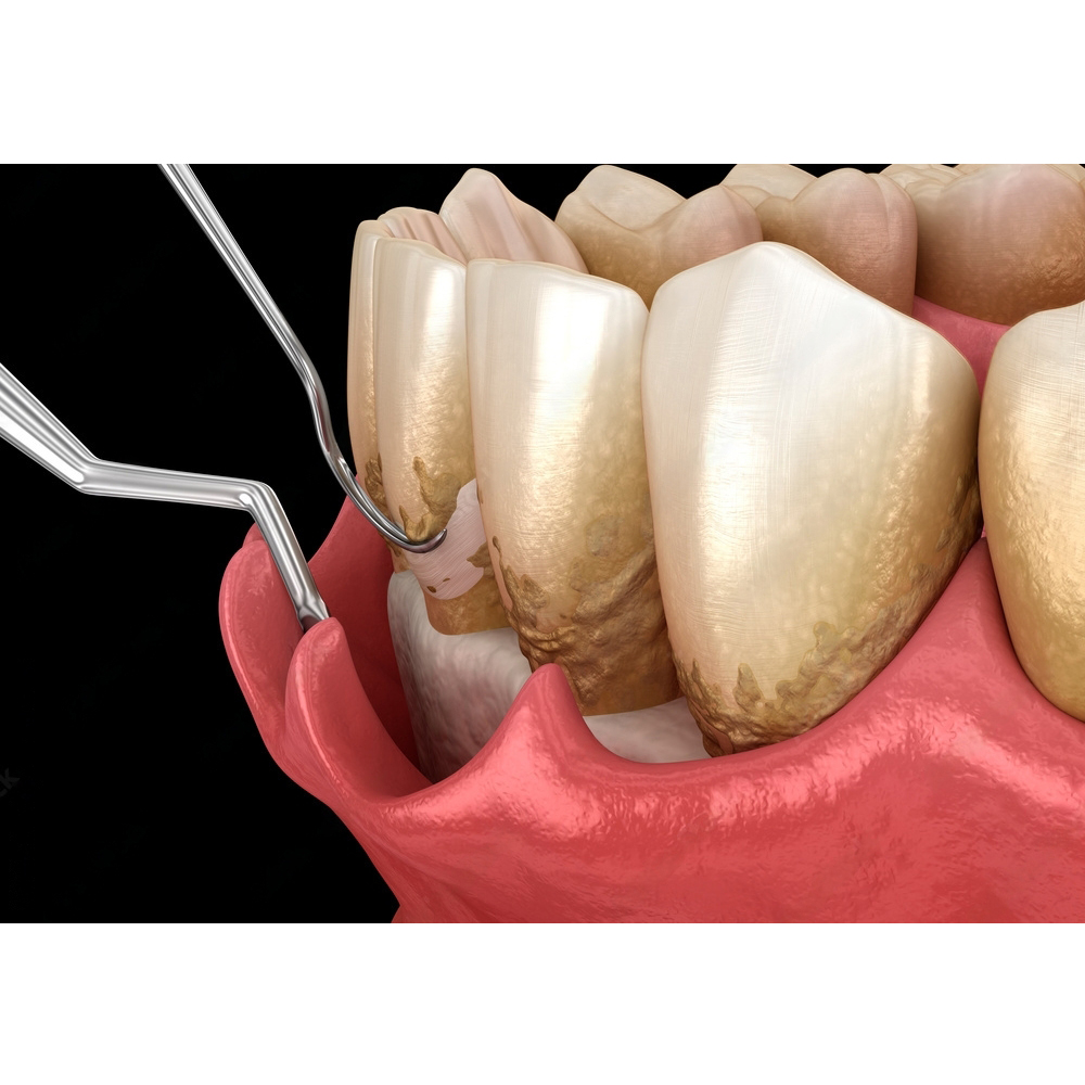 GDC Gracey Curettes Cc Anterior Incisors And Canines # 7 (Sgcc1/2)