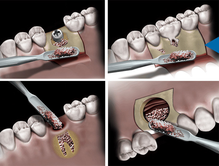 Novabone Porous Granules 1 x 0.5cc (0.25gm)
