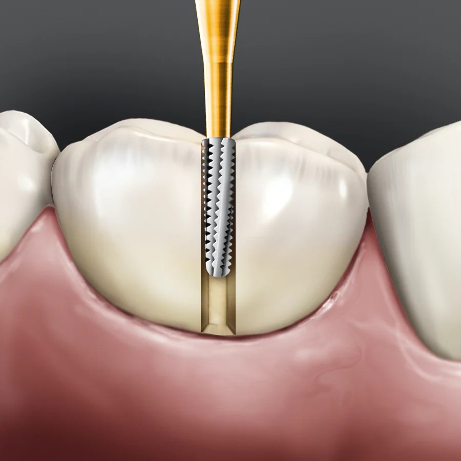 Coltene Crown Cutter Bur