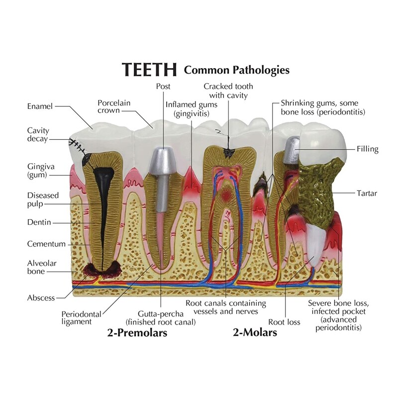 iDENTical Diseased Teeth and Gums Model M4029