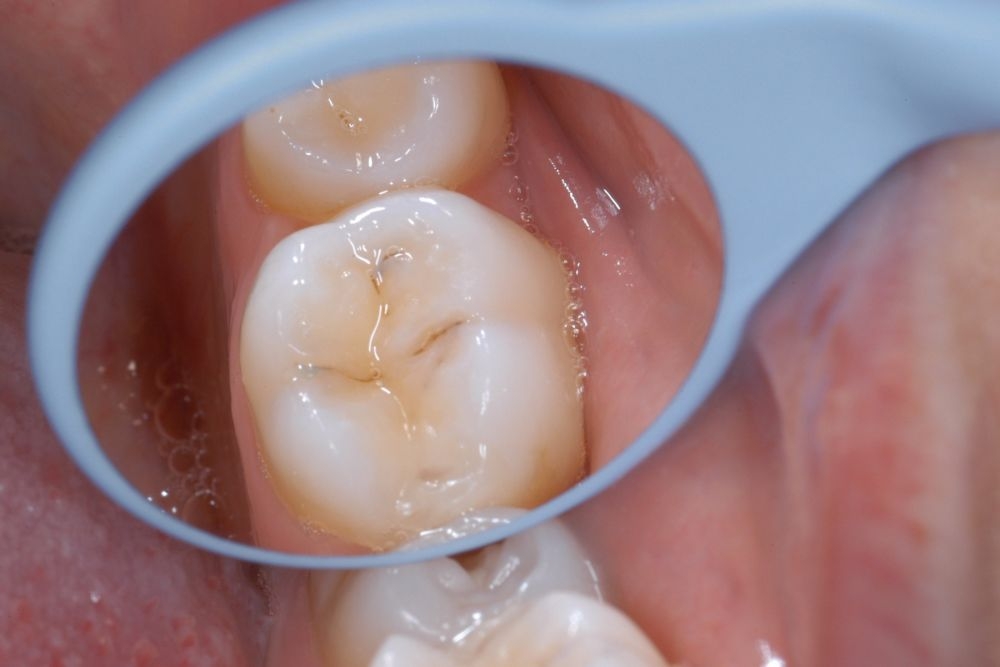 Hahnenkratt Relax FS Rhodium Mouth Mirror #5 Assorted Pack Of 10 (7110)