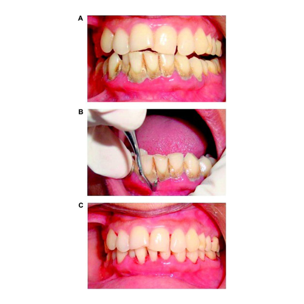 GDC Manipal Scaler Set Of 3 Pcs Instruments Kit (MS3)