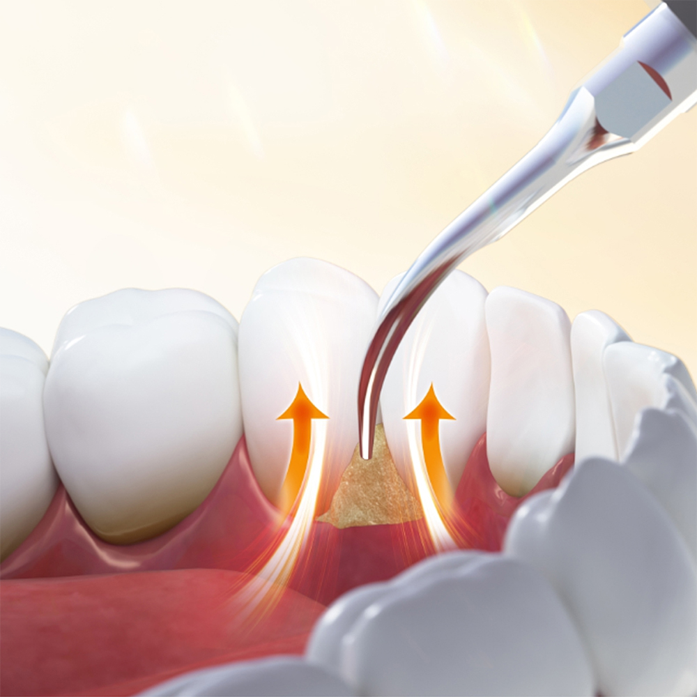 Woodpecker DTE D3 Ultrasonic Scaler Handpiece