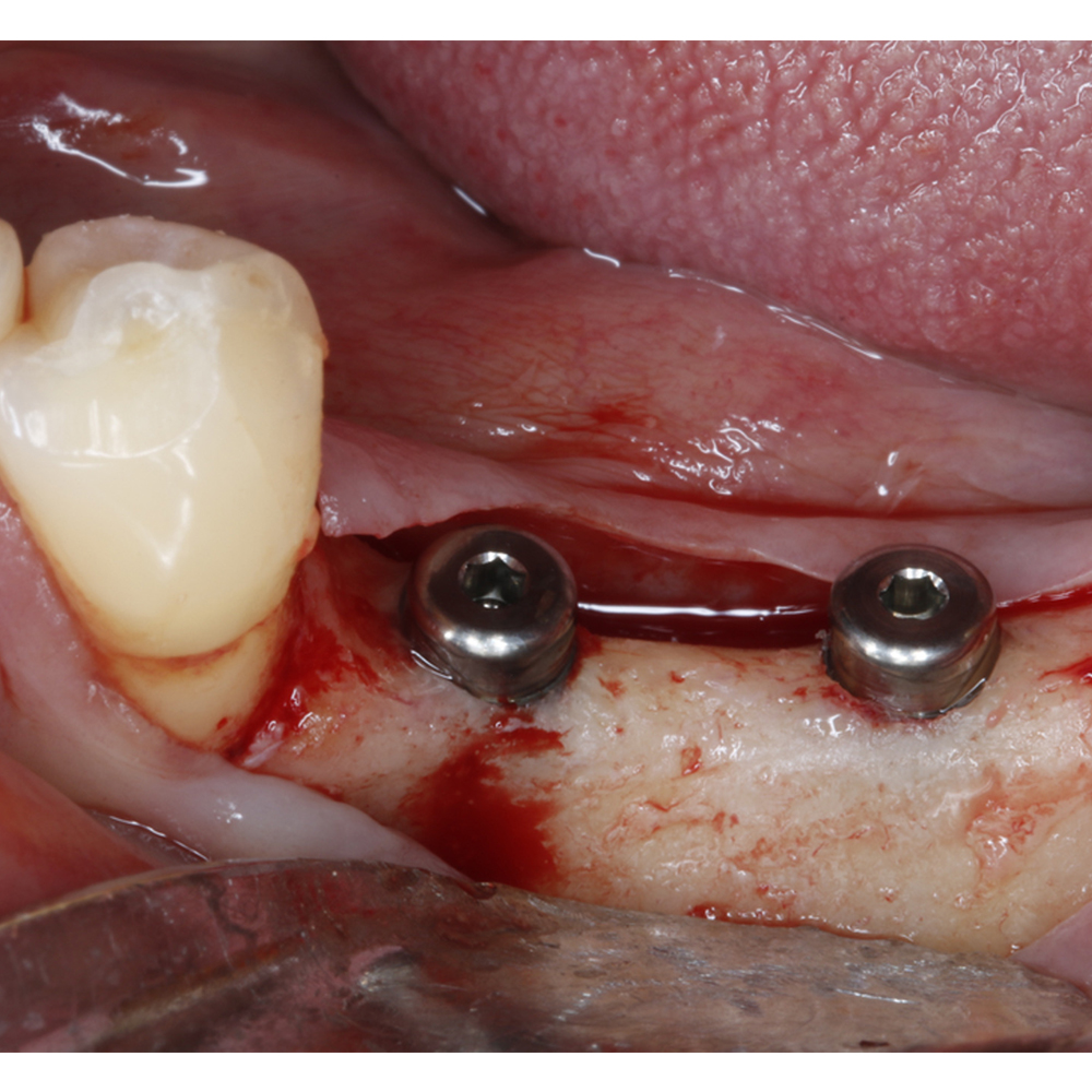 Xcem Dental Implant Submerged Healing Abutment 6mm