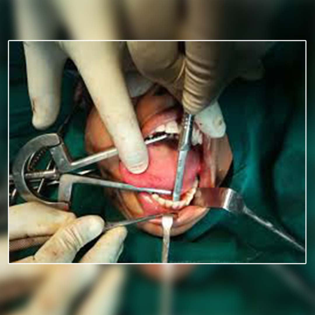 Waldent Heister Mouth Gag 8/112