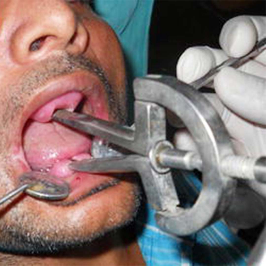 Waldent Heister Mouth Gag 8/112