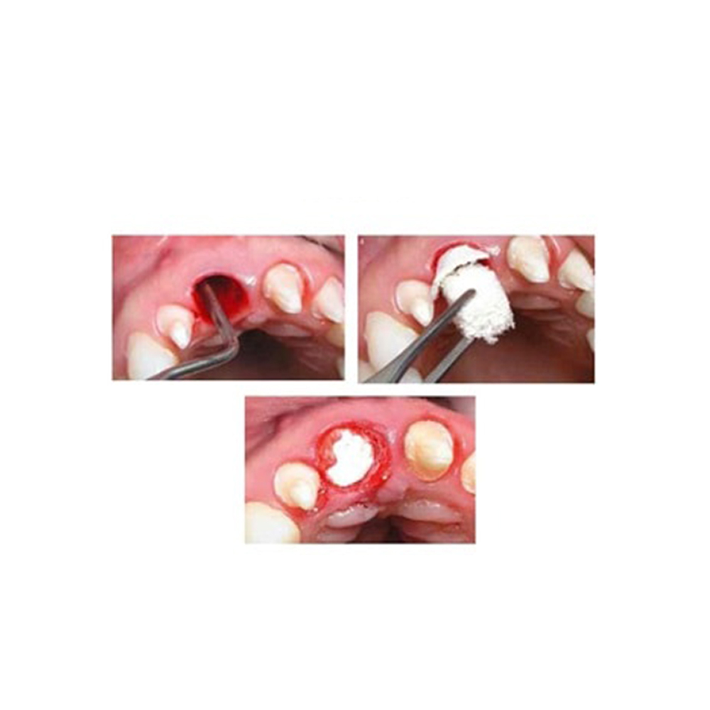 Goodwill Hemosponge 20x20x7mm Absorbable Gelatin Sponge