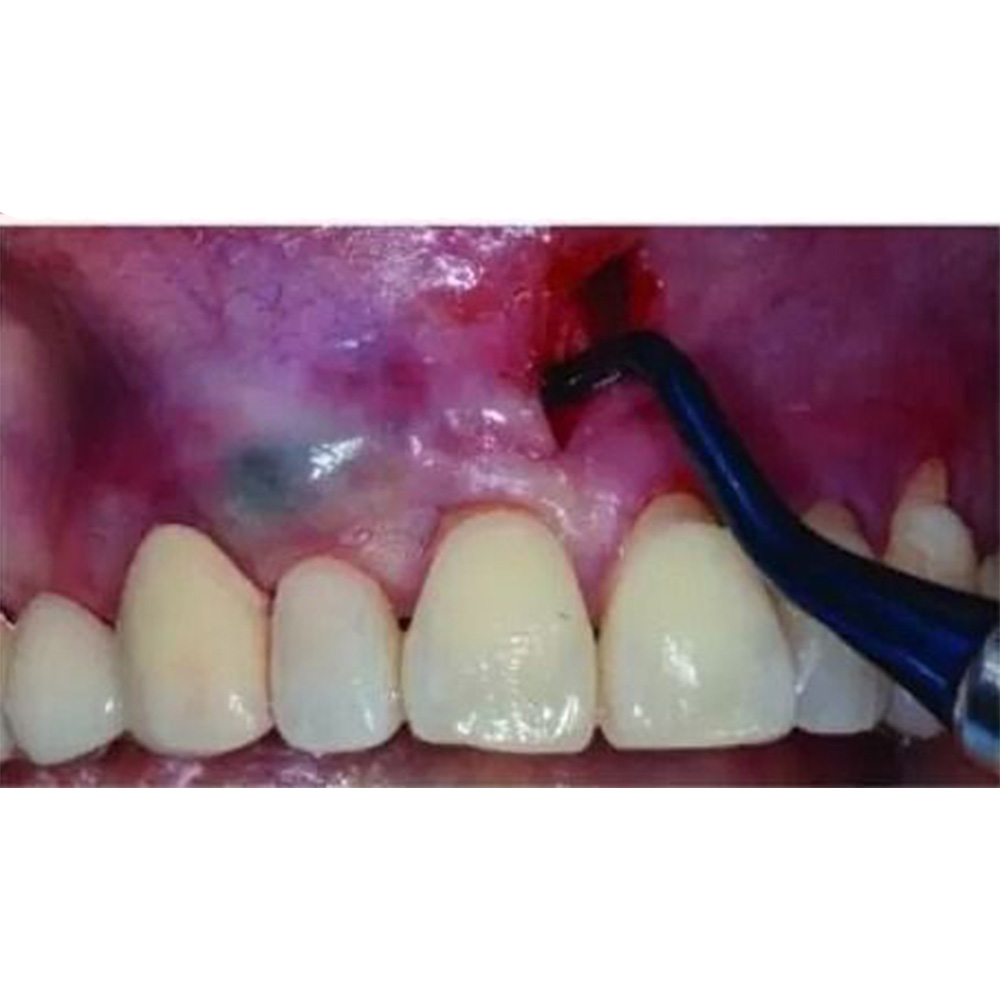 GDC Vista Tunneling Procedure Instrument