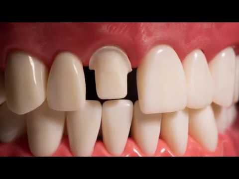 API Typodont Teeth Set with Screw