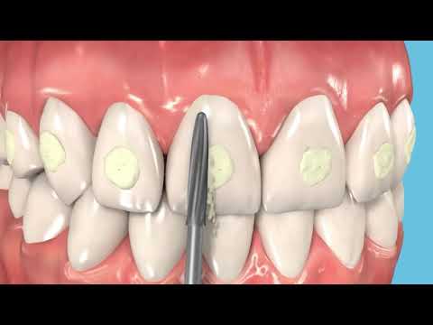 Prima Dental Orthodontic Debonding Bur (safe end)