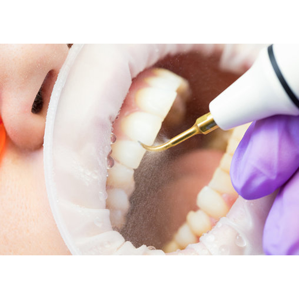 Woodpecker Ultrasonic Scaler Handpiece - HW