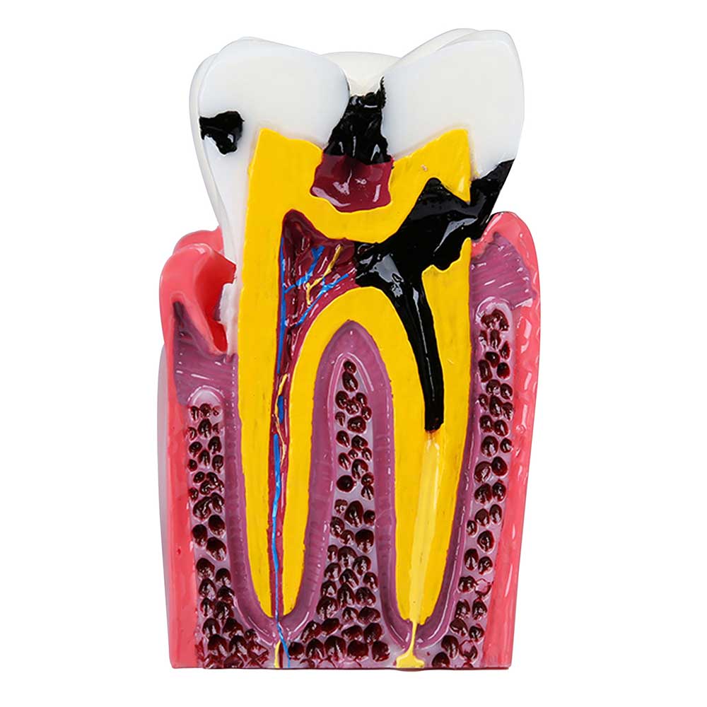 iDENTical Caries V/S Healthy Teeth Model M4021