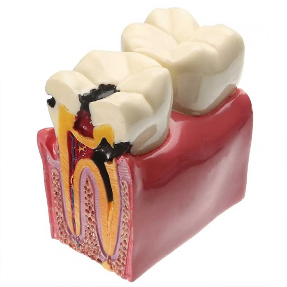 iDENTical Caries V/S Healthy Teeth Model M4021