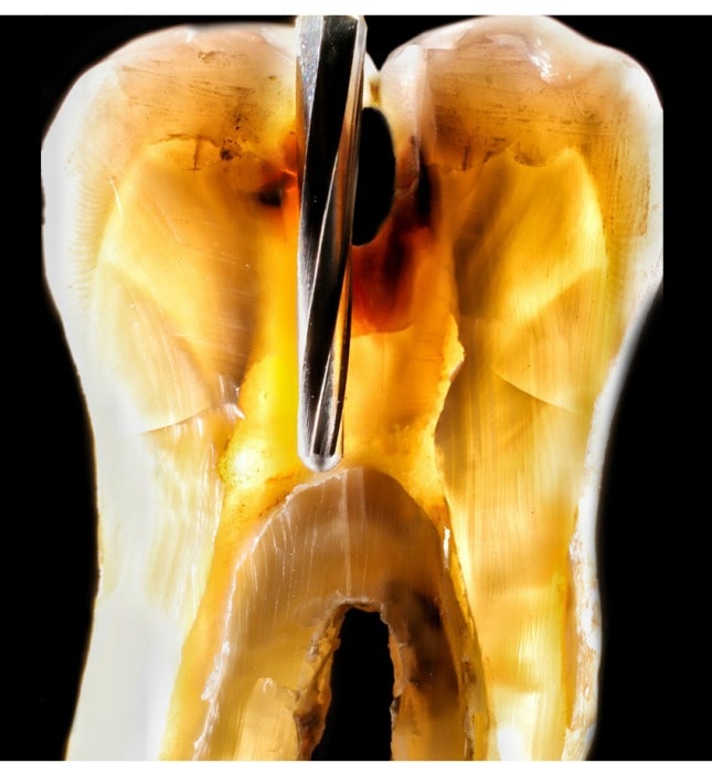 Prima Dental Endodontic Access Kit