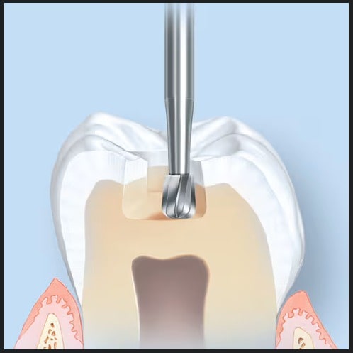 Prima Dental Inverted Cone Bur 