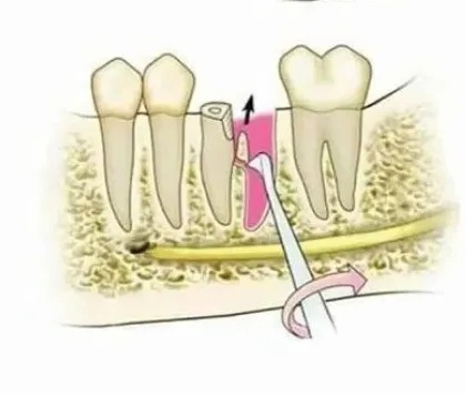 GDC Root Elevators Seldin Standard (E1r)