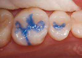 Prime Dental Etching Liquid - 15ml