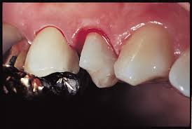 Prevest Hemostal Gel