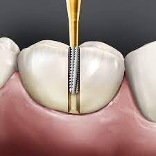 Prima Dental Predator Accuprep Crown Preparation Carbides Kit