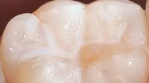 3m Espe Clinpro Sealant - Refills