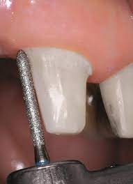 NewDiamond Crown Cutting Diamond Bur -CR (Pack Of 3)