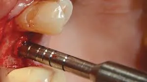 Api+ Osteotomes Concave With Stoppers Set of 10