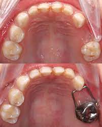 Kids-e-Dental Straight Loops (Pk of 10)