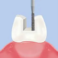 Frank Dental Cylinder Flat End FG Diamond Bur - Pack of 5