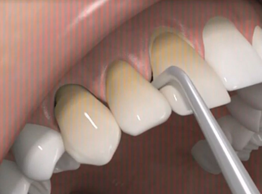 Waldent Crown Remover Tips