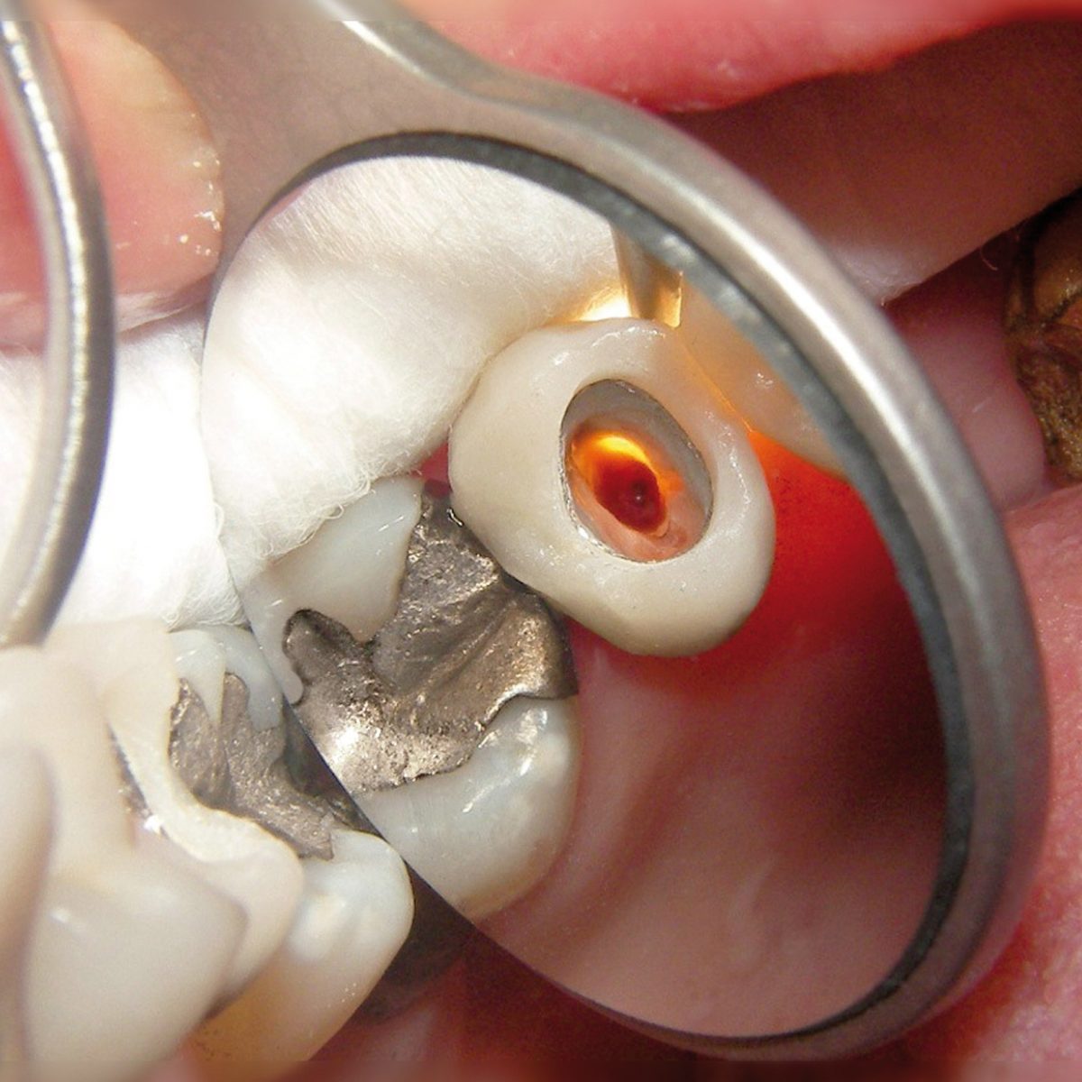 Waldent Rhodium Coated Mouth Mirror Tops (Pack of 1)