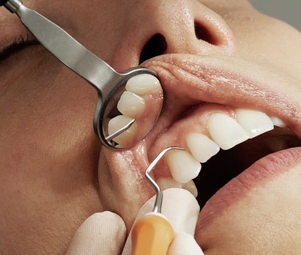 Waldent Rhodium Coated Mouth Mirror Tops (Pack of 1)