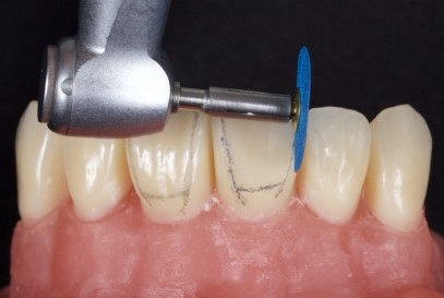 ET Dental Polishing Discs With Rivets Kit