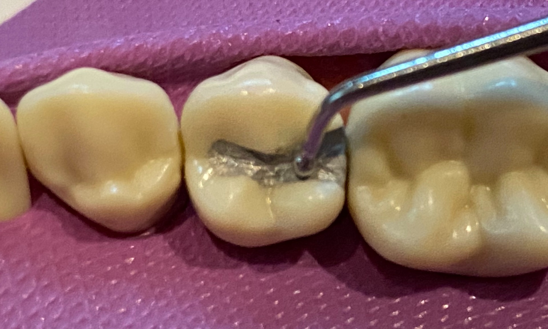 GI Dental Ball Burnisher