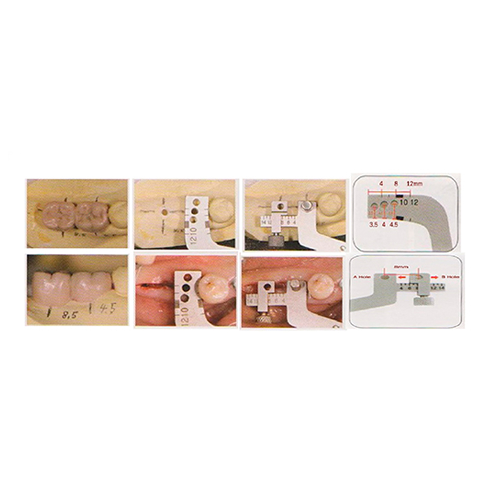 Julldent Mesio Distal Implant Surgical Guide (Dr. Mathai Design)