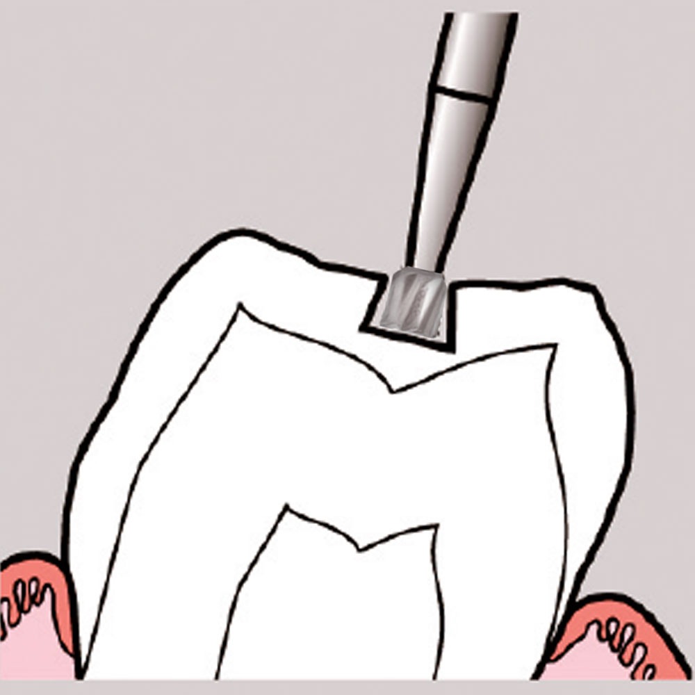 Frank Dental Carbide Bur C.2.023.HP -Pk/1 (Made in Germany)