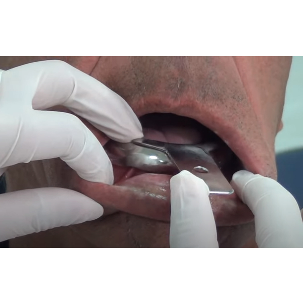 GDC Edentulous Non-Perforated Impression Trays Lower #2 (ITRLEDNPL2)