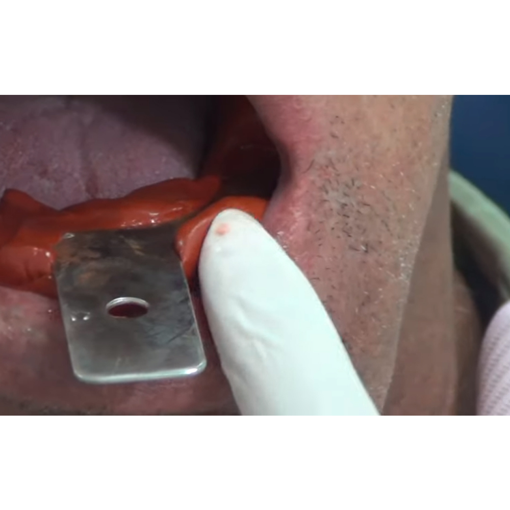 GDC Edentulous Non-Perforated Impression Trays Lower # 1 (ITRLEDNPL1)