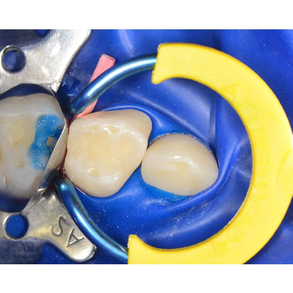 Polydentia myJunior Paediatric Sectional Matrix System Kit