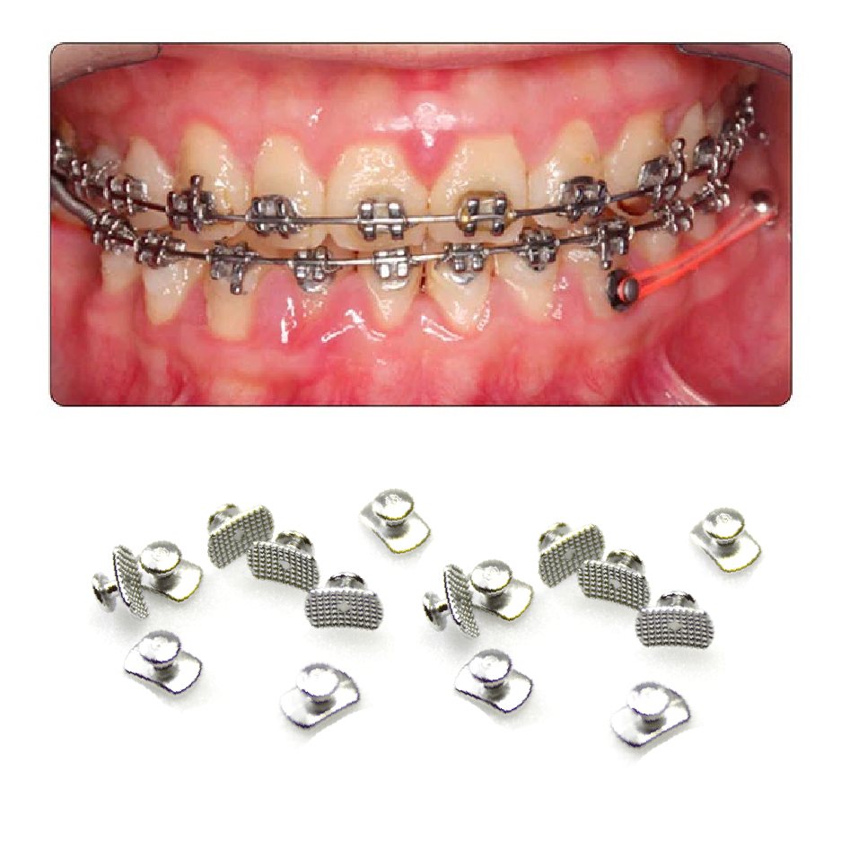 Ortho Direct Lingual Buttons