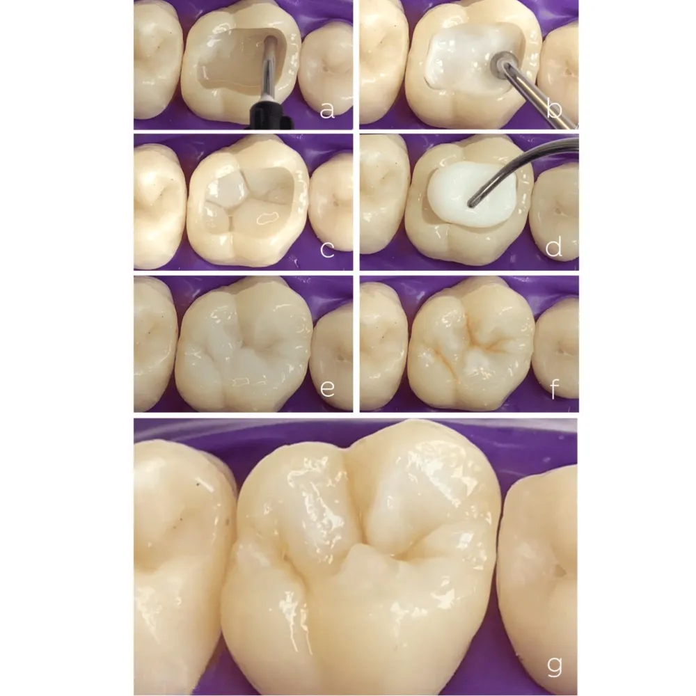 KidseRestore Self Adhesive Flowable GIC