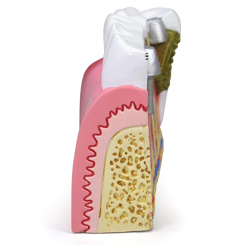 iDENTical Diseased Teeth and Gums Model M4029
