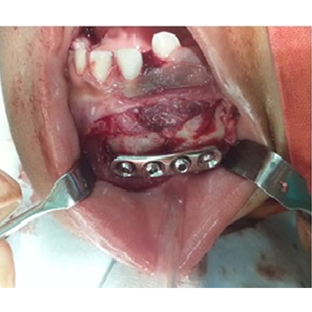 GDC Cheek Retractor Langenbeck - 30x10 (215mm) (CRL1)