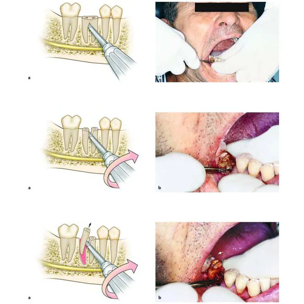 GDC Root Elevators Lindo Levian Straight - (2.5x5mm) Standard (Lls3)