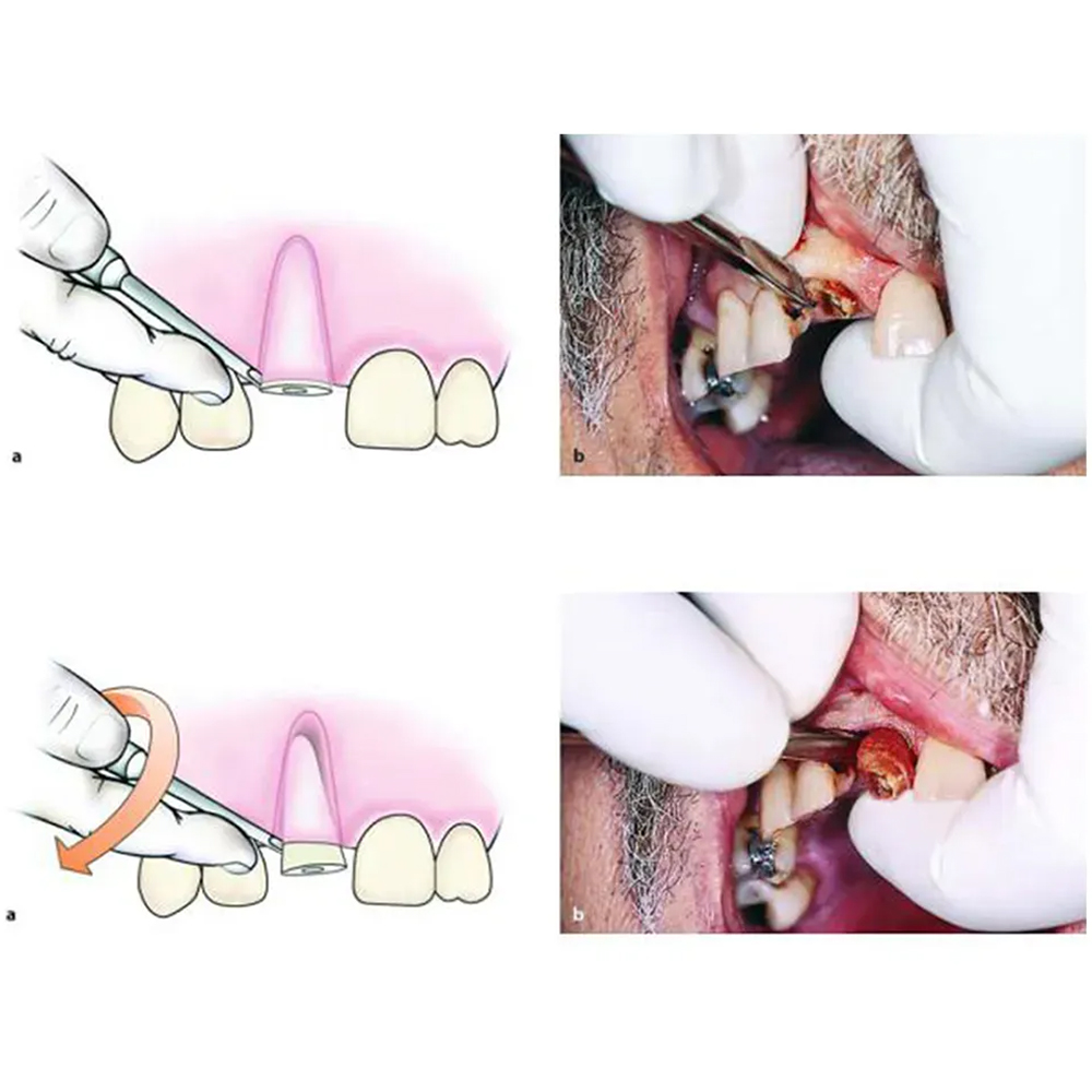 GDC Root Elevators Lindo Levian Curved - (3x8mm) Standard (Llmc5)