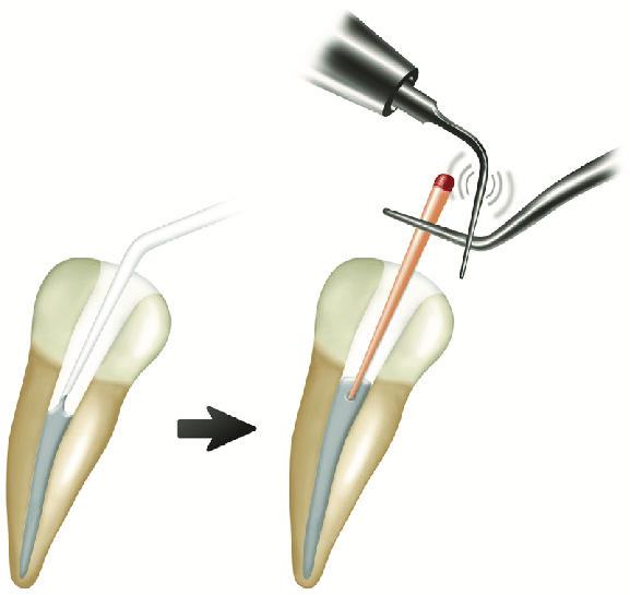 Diadent Gutta Percha Non Standardized
