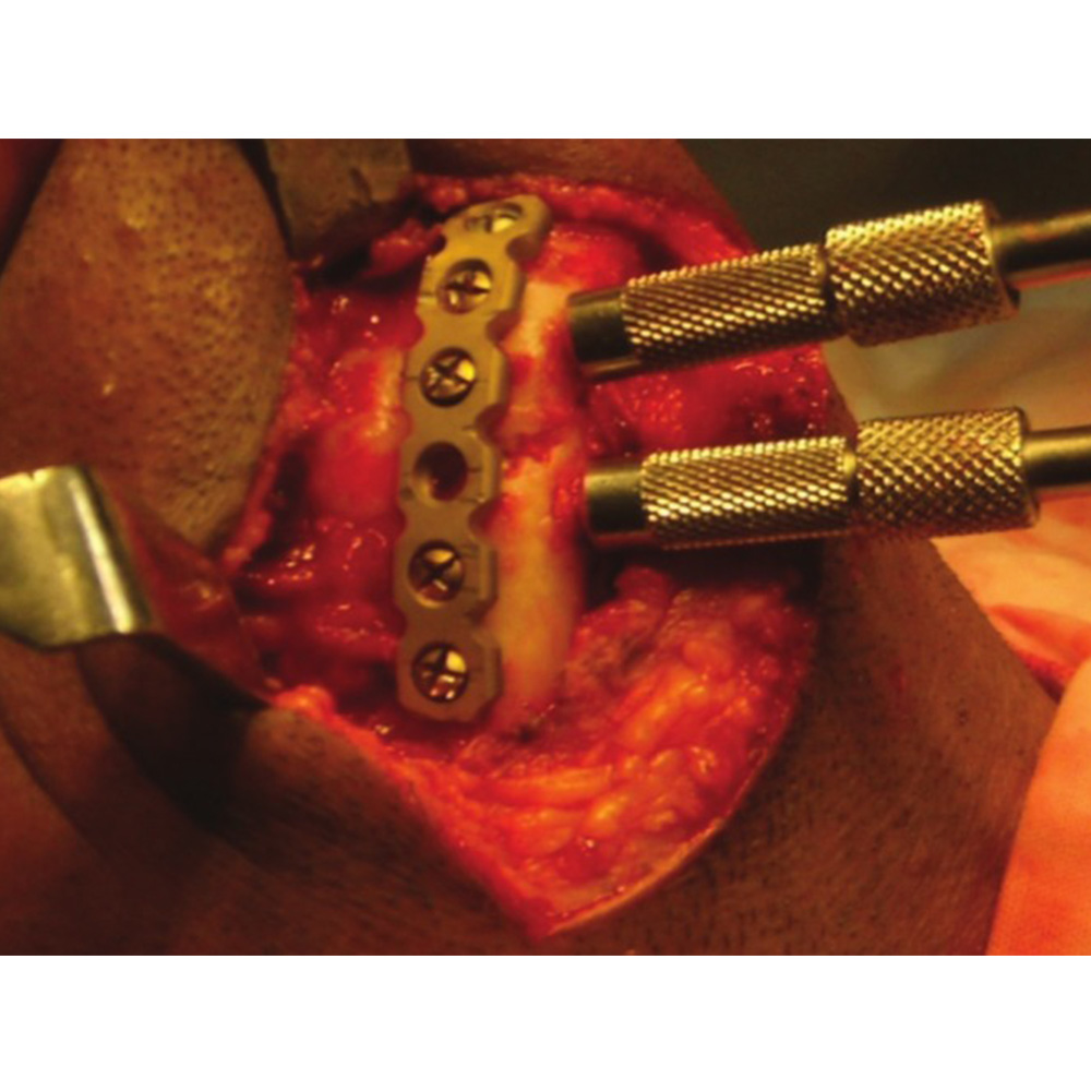 SK Surgicals SS Mini Bone Locking Plates - 2mm